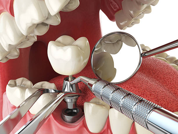 Best Emergency Tooth Extraction  in USA